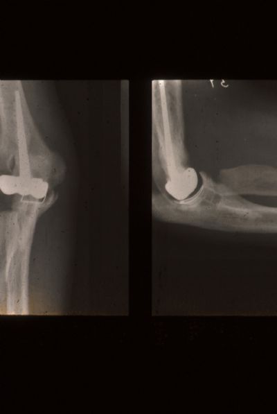 Ewald Resurfacing Total Elbow Prosthesis (Implant 90)